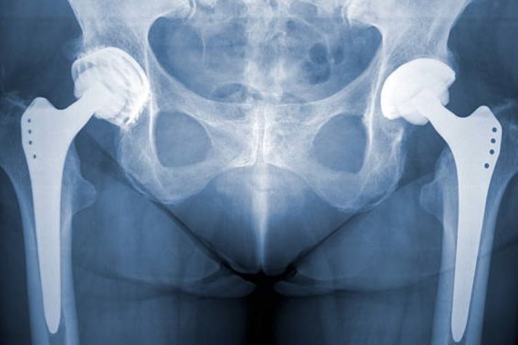 Microorganisms grow on body implants
