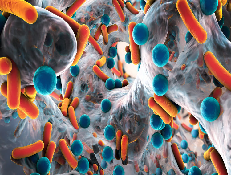 Using calcium sulphate in the fight against antimicrobial resistance
